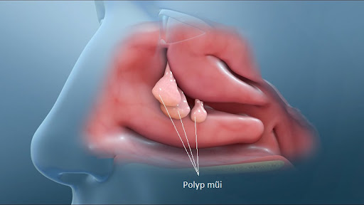 Polyp mũi gây cản trở đường hô hấp