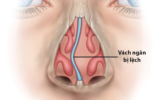 Vách ngăn mũi bị lệch gây ra nghẹt mũi 1 bên