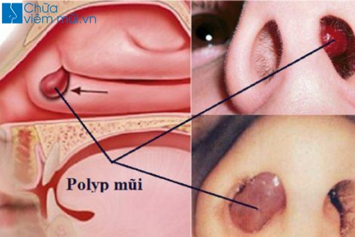 Polyp mũi là nguyên nhân gây nghẹt mũi lâu ngày