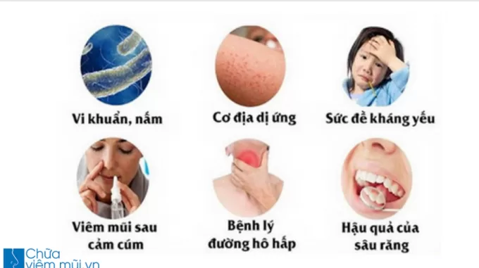 3 Cách điều trị viêm xoang mũi dứt điểm mới nhất