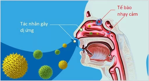 Bệnh viêm mũi dị ứng gây ra do tiếp xúc với các kháng nguyên ngoài môi trường