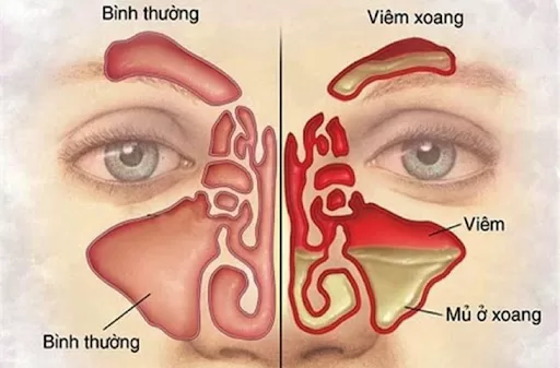 ​ Dịch nhày ứ đọng gây ra tắc nghẽn mũi xoang