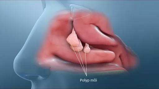 ​ Polyp mũi gây cản trở đường hô hấp