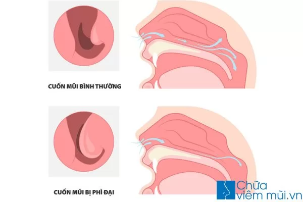 Nghẹt mũi là tình trạng một hoặc cả hai lỗ mũi bị tắc nghẽn