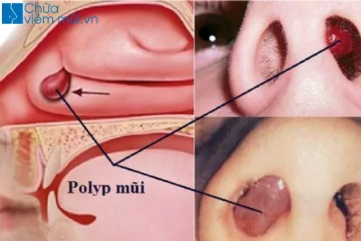 ​ Polyp mũi là nguyên nhân gây nghẹt mũi lâu ngày