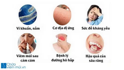 5 bí quyết đơn giản giúp trị bệnh viêm xoang mạn tính tại nhà hiệu quả nhất