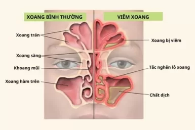 Chớ chủ quan với các triệu chứng viêm xoang điển hình