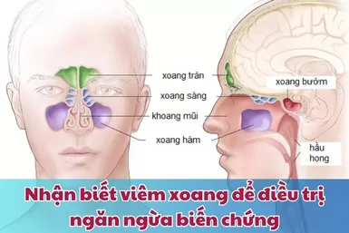 Nhận biết viêm xoang để điều trị ngăn ngừa biến chứng