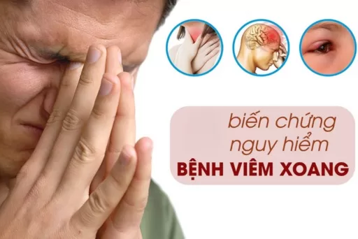 ​ Viêm xoang nếu không được điều trị đúng cách sẽ dẫn đến biến chứng nguy hiểm