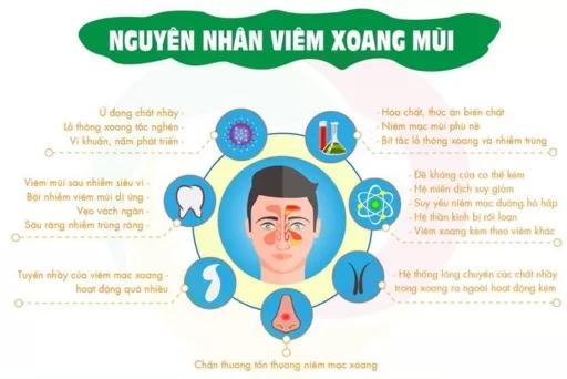 ​ Nguyên nhân thường gặp gây bệnh viêm xoang