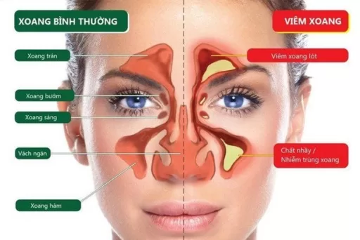 ​ Tắc nghẽn xoang khiến cho không khí và chất nhầy không thể lưu thông