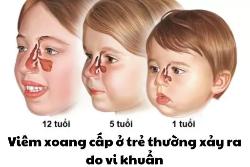 ​ Viêm xoang cấp ở trẻ thường xảy ra do vi khuẩn