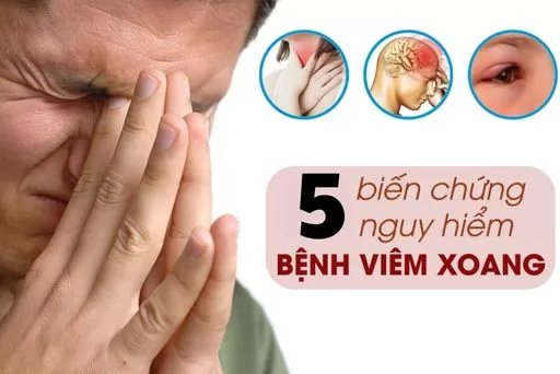 ​ Các biến chứng nguy hiểm có thể gặp ở viêm xoang