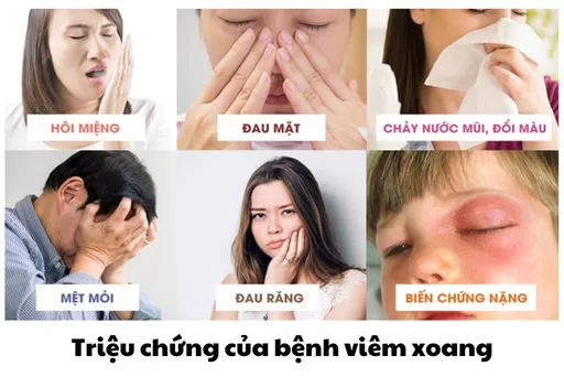 ​ Triệu chứng của bệnh viêm xoang mạn tính