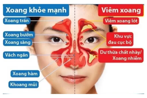 ​ Viêm xoang là tình trạng niêm mạc lớp lót bên trong bị viêm