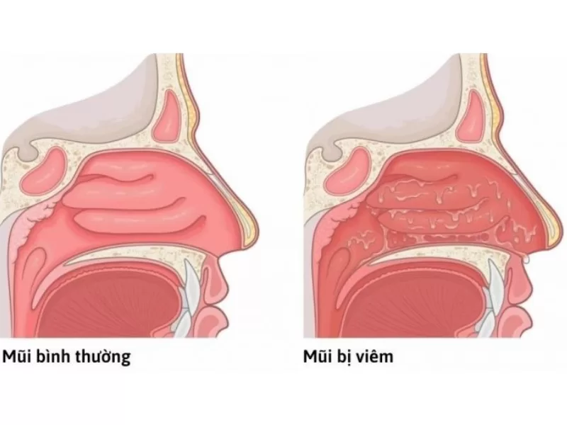 Các triệu chứng của bệnh viêm mũi