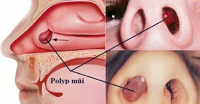 Polyp mũi có thể là nguyên nhân gây nghẹt mũi kéo dài