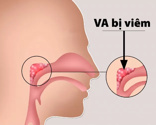 Trẻ bị viêm VA kéo dài có thể khiến đường thở bị hẹp gây nghẹt mũi