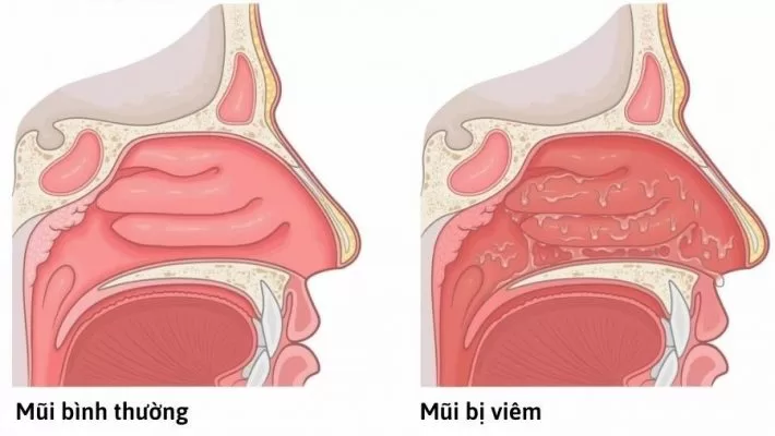 Có những cách trị viêm mũi dứt điểm nào? Bước đầu tiên trong điều trị là làm giảm nhanh các triệu chứng viêm
