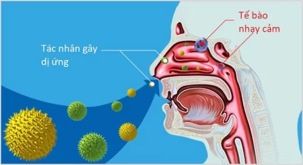 Viêm mũi có thể xảy ra khi cơ thể phản ứng quá mức với các tác nhân dị ứng