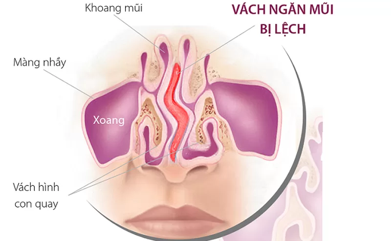 Bị nghẹt mũi 1 bên: Nguyên nhân phổ biến và cách cải thiện hiệu quả Người bị lệch vách ngăn có thể bị nghẹt mũi 1 bên