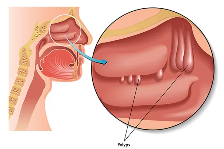 Bị nghẹt mũi 1 bên: Nguyên nhân phổ biến và cách cải thiện hiệu quả Polyp mũi có thể làm hẹp đường thở gây nghẹt mũi