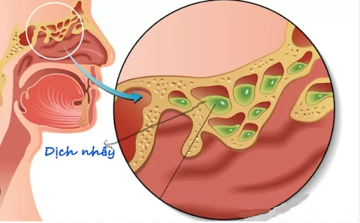 Lượng dịch tăng bất thường, kèm theo viêm niêm mạc – khiến mũi bị bít kín gây tắc mũi