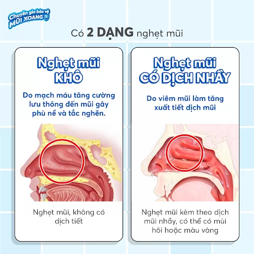 Làm thế nào để hết tắc mũi nhanh chóng, hiệu quả? Phân biệt triệu chứng rõ ràng giúp điều trị hiệu quả hơn