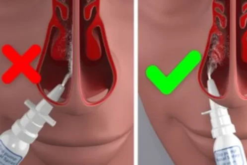 Xịt rửa mũi nhiều có tốt không? Hướng dẫn sử dụng an toàn và hiệu quả Cần xịt mũi đúng cách để đảm bảo an toàn