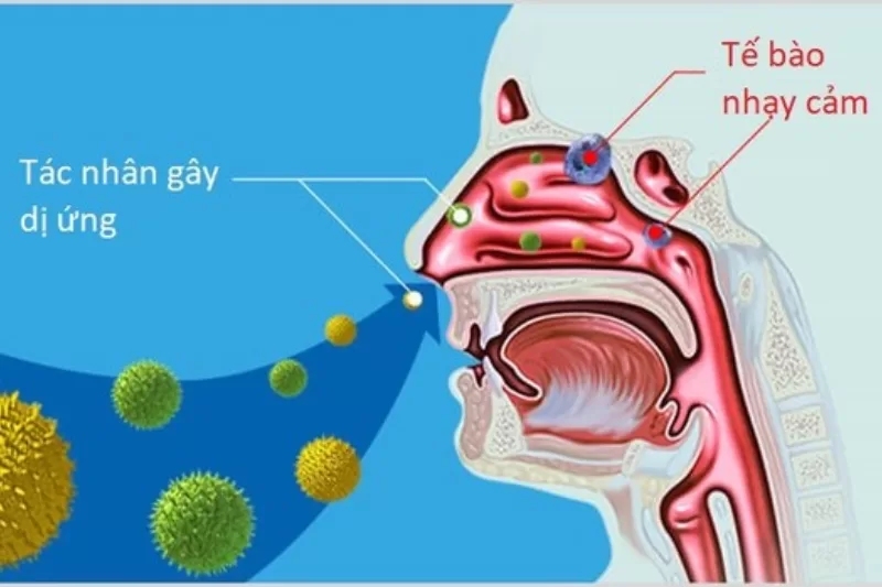 Cách điều trị viêm mũi tại nhà: Giảm triệu chứng nhanh, ngăn ngừa tái phát Có nhiều nguyên nhân gây nghẹt mũi chủ yếu là dị ứng và nhiễm trùng