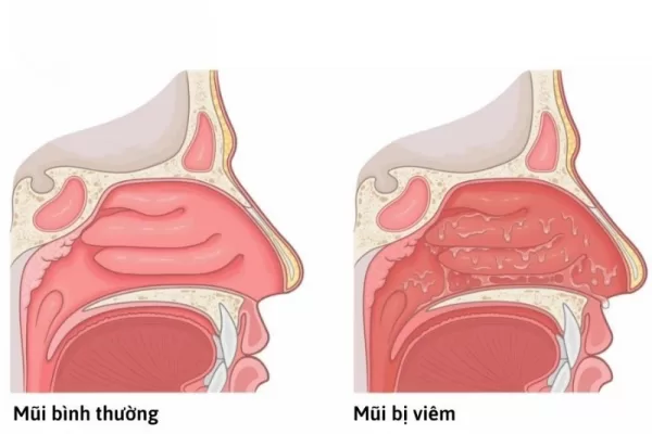 Khi viêm mũi, triệu chứng thường gặp là sổ mũi, nghẹt mũi