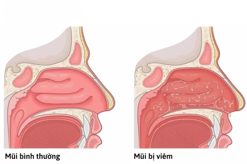 Cách điều trị viêm mũi tại nhà: Giảm triệu chứng nhanh, ngăn ngừa tái phát Khi viêm mũi, triệu chứng thường gặp là sổ mũi, nghẹt mũi
