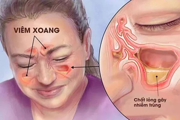 Cách điều trị bệnh viêm xoang cấp: Phác đồ chuẩn y khoa và chăm sóc tại nhà hiệu quả