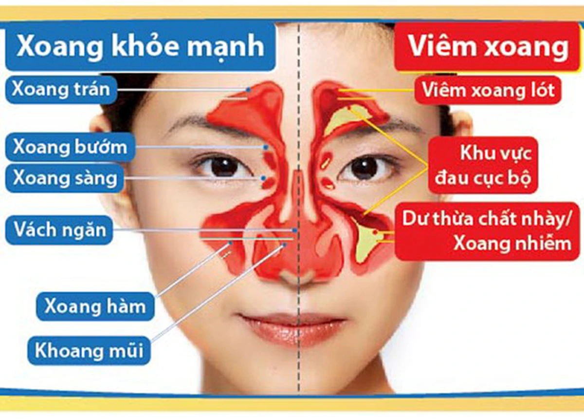 Dịch nhầy ứ đọng khiến cho các xoang cạnh mũi bị viêm