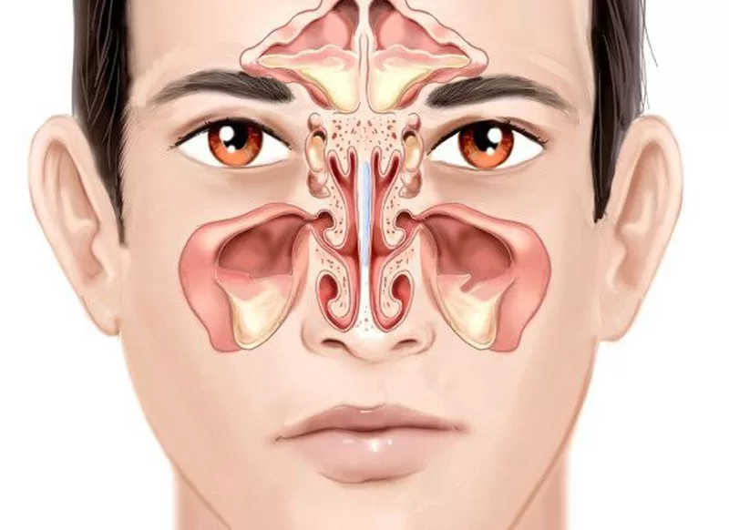 bệnh viêm mũi có nguy hiểm không?