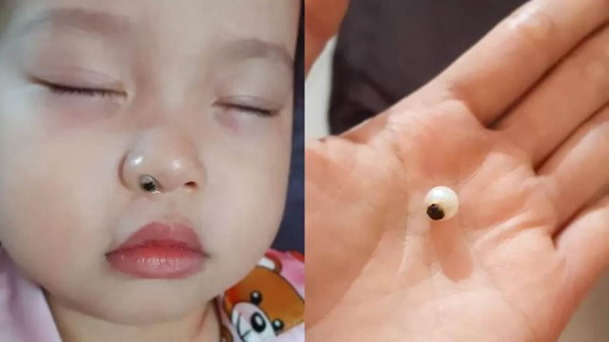 Tại sao bị nghẹt mũi 1 bên? Nguyên nhân, cách điều trị hiệu quả Nghẹt mũi 1 bên  do trẻ nhét dị vật vào mũi