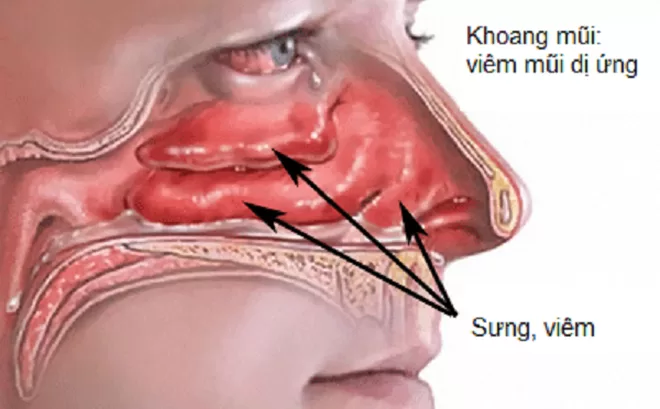 Nguyên nhân phổ biến gây nghẹt mũi 1 bên luân phiên là do viêm mũi dị ứng