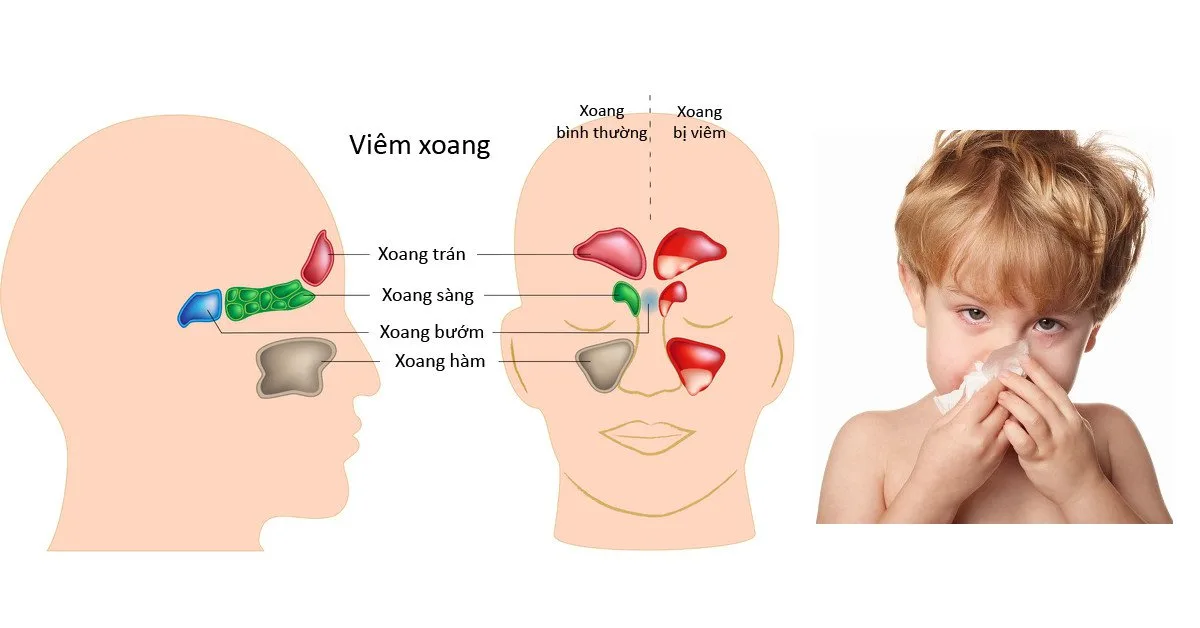 Hiểu rõ nguyên nhân của bệnh viêm xoang cấp để điều trị dứt điểm, tránh tái phát Viêm xoang có thể gặp ở trẻ em
