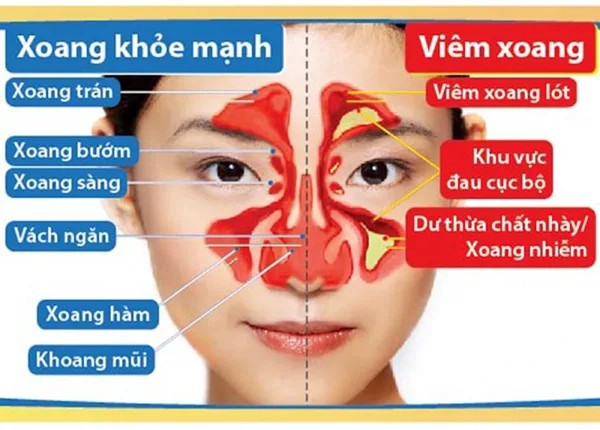 Viêm xoang là tình trạng niêm mạc bị viêm, dịch nhầy tích tụ gây tắc nghẽn xoang
