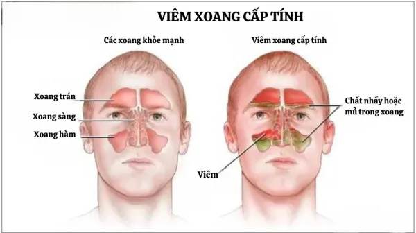 Viêm xoang cấp tính là tình trạng viêm xoang kéo dài dưới 4 tuần