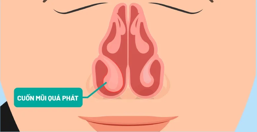 Cuốn mũi sung huyết là gì? Nguyên nhân và cách xử lý hiệu quả