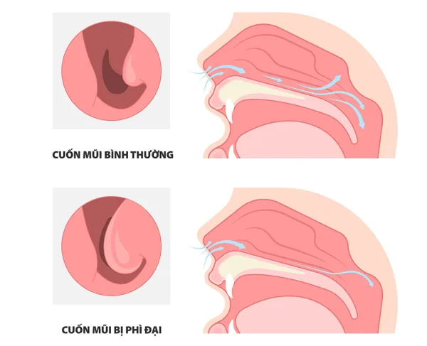 Nguyên nhân phù nề mũi: Những yếu tố phổ biến khiến niêm mạc mũi bị sưng
