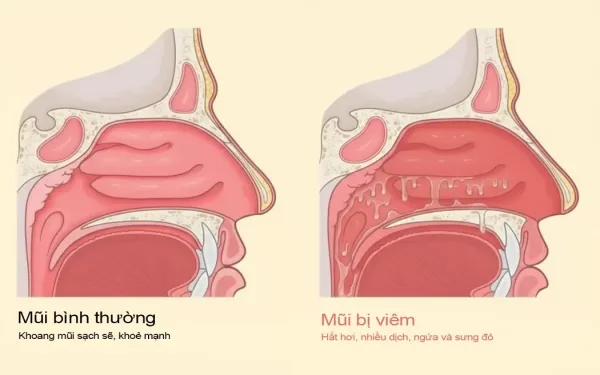 Viêm mũi dị ứng là tình trạng niêm mạch mũi phù nề